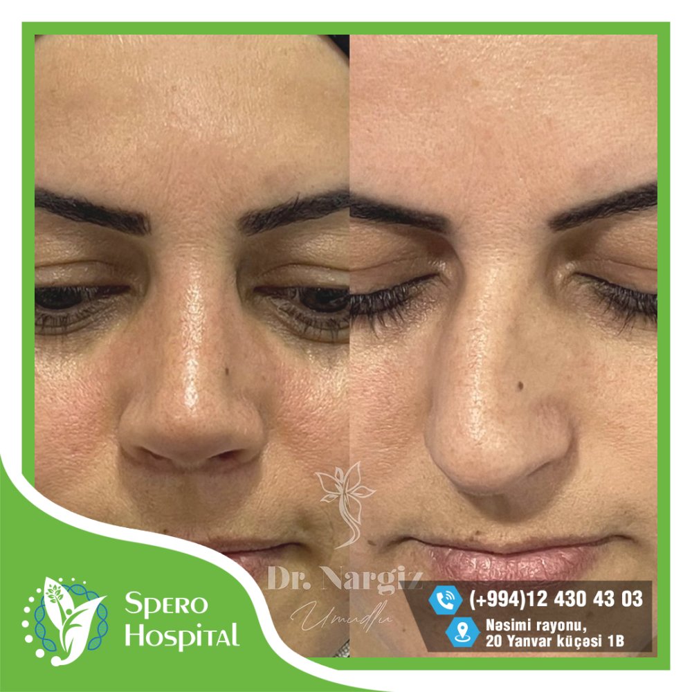 Rinoplastika