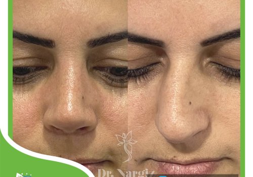 Rinoplastika